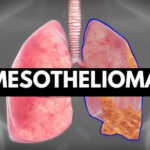 oklahoma city mesothelioma lawyer vimeo